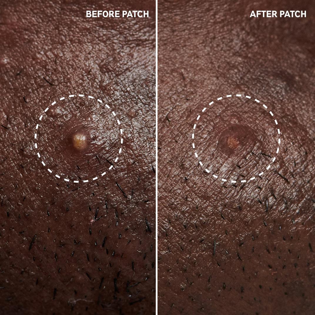 INKEY Hydrocolloid Invisible Pimple Patches + Salicylic Acid